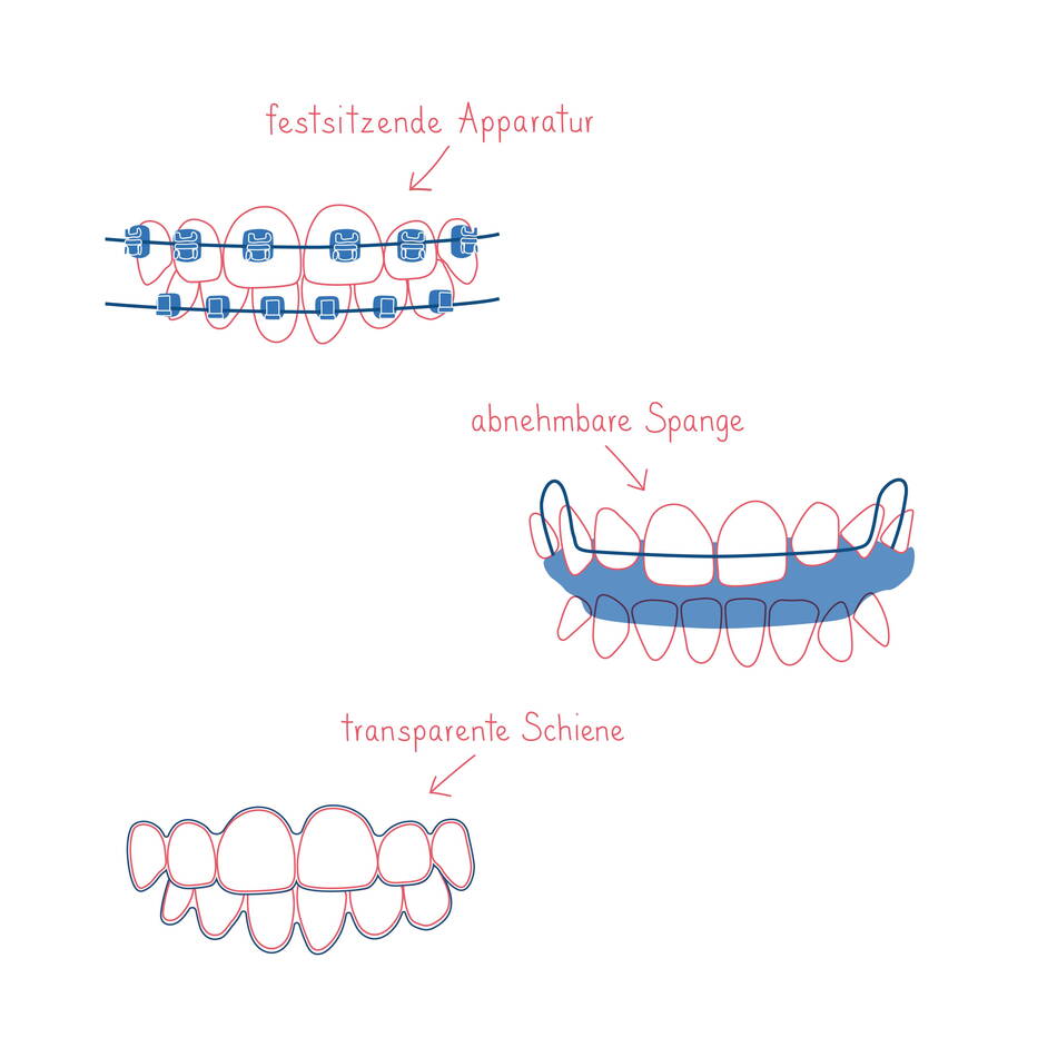 illustrationen_spangentypen.jpg